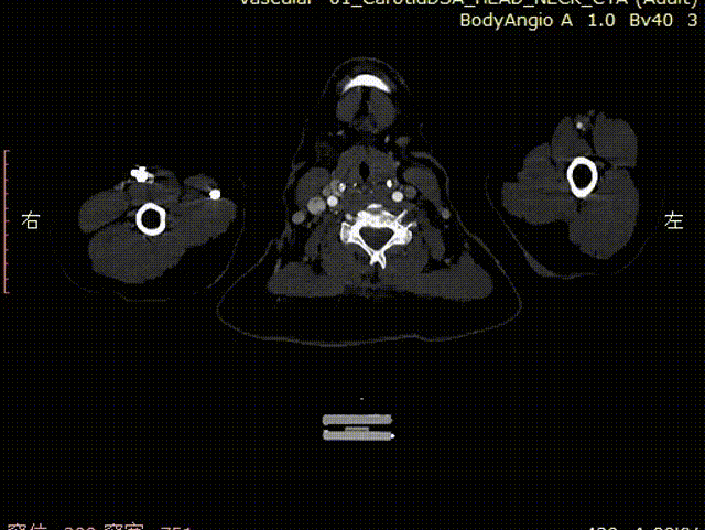 gore医疗怎么样「胸有乾坤」化险为夷，通险畅机——GORE® TAG® 胸主动脉覆膜支架治疗累及异形弓部动脉瘤_https://www.jmylbn.com_新闻资讯_第6张
