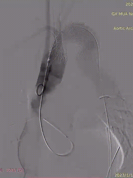 gore医疗怎么样「胸有乾坤」化险为夷，通险畅机——GORE® TAG® 胸主动脉覆膜支架治疗累及异形弓部动脉瘤_https://www.jmylbn.com_新闻资讯_第22张