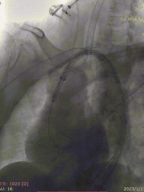 gore医疗怎么样「胸有乾坤」化险为夷，通险畅机——GORE® TAG® 胸主动脉覆膜支架治疗累及异形弓部动脉瘤_https://www.jmylbn.com_新闻资讯_第17张