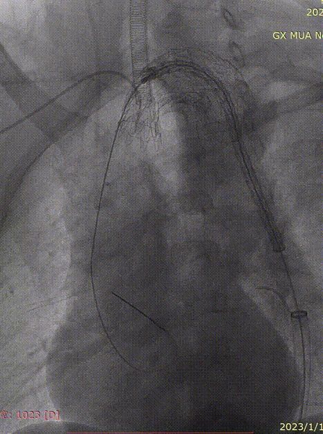 gore医疗怎么样「胸有乾坤」化险为夷，通险畅机——GORE® TAG® 胸主动脉覆膜支架治疗累及异形弓部动脉瘤_https://www.jmylbn.com_新闻资讯_第23张