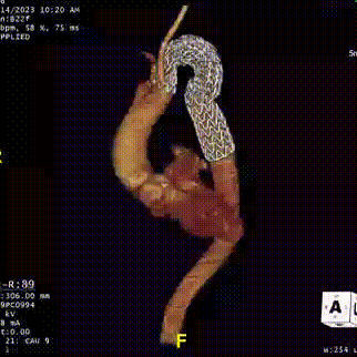 gore医疗怎么样「胸有乾坤」化险为夷，通险畅机——GORE® TAG® 胸主动脉覆膜支架治疗累及异形弓部动脉瘤_https://www.jmylbn.com_新闻资讯_第28张