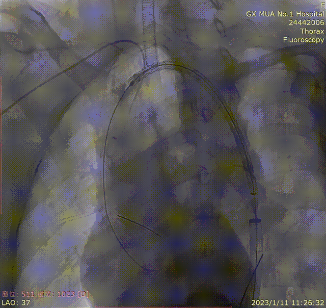gore医疗怎么样「胸有乾坤」化险为夷，通险畅机——GORE® TAG® 胸主动脉覆膜支架治疗累及异形弓部动脉瘤_https://www.jmylbn.com_新闻资讯_第20张