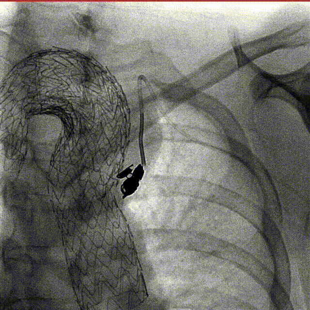 gore医疗怎么样「胸有乾坤」化险为夷，通险畅机——GORE® TAG® 胸主动脉覆膜支架治疗累及异形弓部动脉瘤_https://www.jmylbn.com_新闻资讯_第27张
