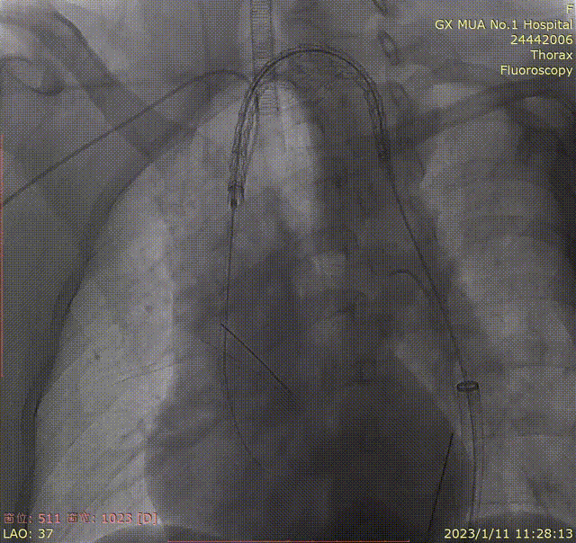 gore医疗怎么样「胸有乾坤」化险为夷，通险畅机——GORE® TAG® 胸主动脉覆膜支架治疗累及异形弓部动脉瘤_https://www.jmylbn.com_新闻资讯_第21张