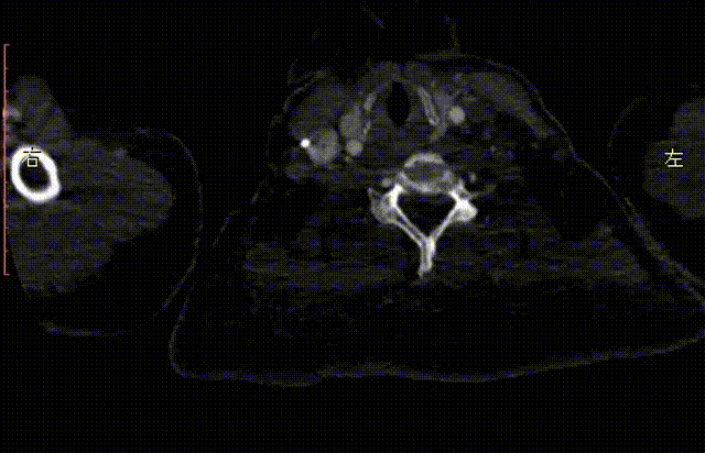 gore医疗怎么样「胸有乾坤」化险为夷，通险畅机——GORE® TAG® 胸主动脉覆膜支架治疗累及异形弓部动脉瘤_https://www.jmylbn.com_新闻资讯_第25张