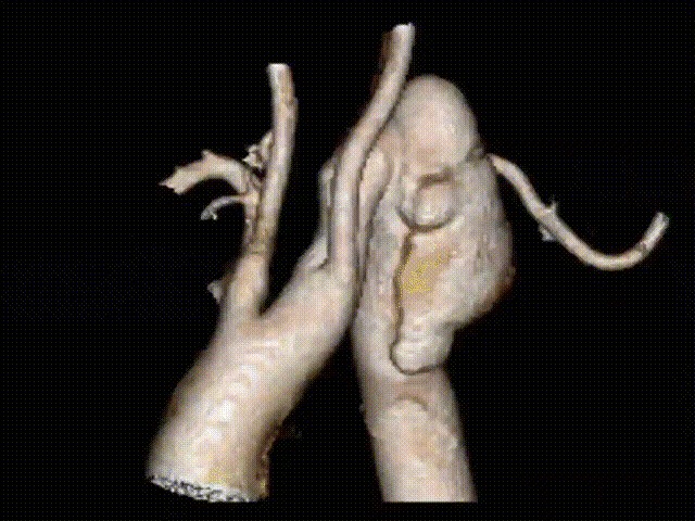 gore医疗怎么样「胸有乾坤」化险为夷，通险畅机——GORE® TAG® 胸主动脉覆膜支架治疗累及异形弓部动脉瘤_https://www.jmylbn.com_新闻资讯_第7张