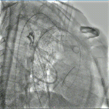 gore医疗怎么样「胸有乾坤」可调可控，从容不迫——GORE® TAG®可主动调控胸主动脉覆膜支架治疗右弓右降伴Kommerell憩室病例_https://www.jmylbn.com_新闻资讯_第18张