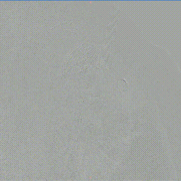 gore医疗怎么样「胸有乾坤」可调可控，从容不迫——GORE® TAG®可主动调控胸主动脉覆膜支架治疗右弓右降伴Kommerell憩室病例_https://www.jmylbn.com_新闻资讯_第17张