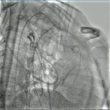 gore医疗怎么样「胸有乾坤」可调可控，从容不迫——GORE® TAG®可主动调控胸主动脉覆膜支架治疗右弓右降伴Kommerell憩室病例_https://www.jmylbn.com_新闻资讯_第16张