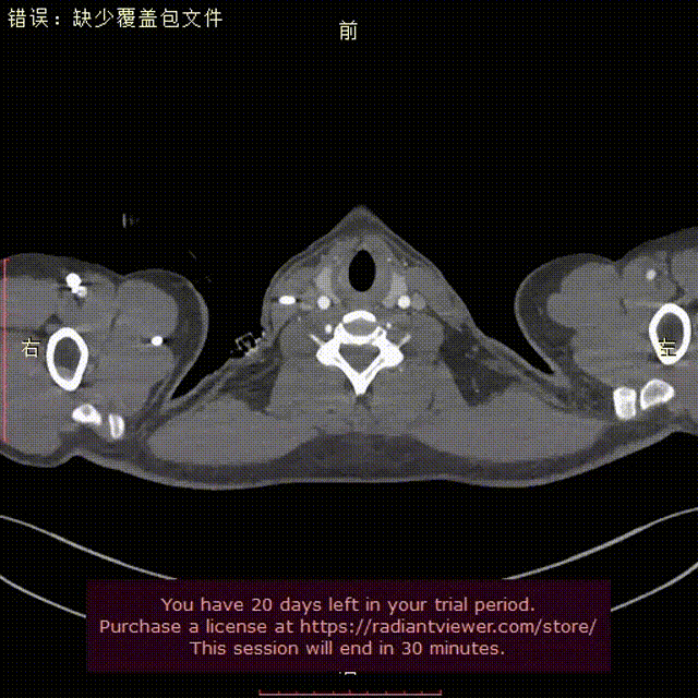 gore医疗怎么样「胸有乾坤」可调可控，从容不迫——GORE® TAG®可主动调控胸主动脉覆膜支架治疗右弓右降伴Kommerell憩室病例_https://www.jmylbn.com_新闻资讯_第21张