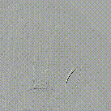 gore医疗怎么样「胸有乾坤」可调可控，从容不迫——GORE® TAG®可主动调控胸主动脉覆膜支架治疗右弓右降伴Kommerell憩室病例_https://www.jmylbn.com_新闻资讯_第19张