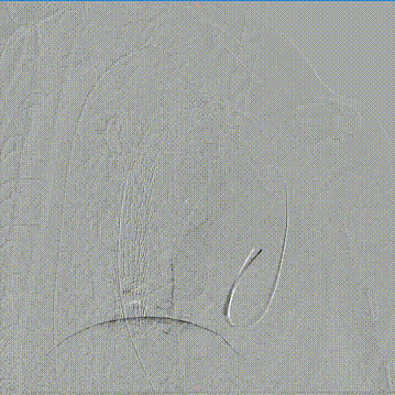 gore医疗怎么样「胸有乾坤」可调可控，从容不迫——GORE® TAG®可主动调控胸主动脉覆膜支架治疗右弓右降伴Kommerell憩室病例_https://www.jmylbn.com_新闻资讯_第15张