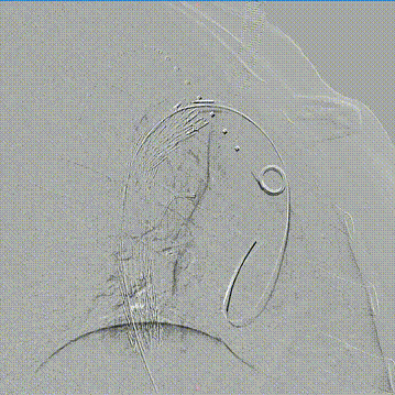 gore医疗怎么样「胸有乾坤」可调可控，从容不迫——GORE® TAG®可主动调控胸主动脉覆膜支架治疗右弓右降伴Kommerell憩室病例_https://www.jmylbn.com_新闻资讯_第14张