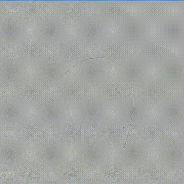 gore医疗怎么样「胸有乾坤」可调可控，从容不迫——GORE® TAG®可主动调控胸主动脉覆膜支架治疗右弓右降伴Kommerell憩室病例_https://www.jmylbn.com_新闻资讯_第13张