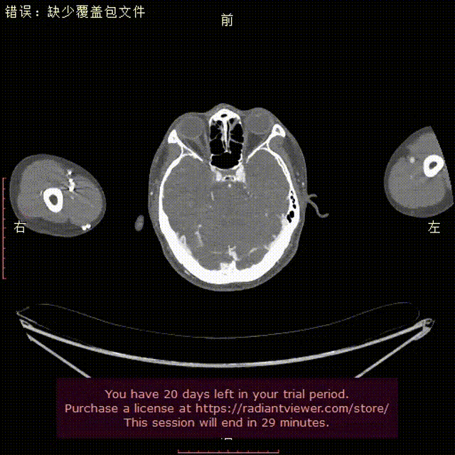 gore医疗怎么样「胸有乾坤」可调可控，从容不迫——GORE® TAG®可主动调控胸主动脉覆膜支架治疗右弓右降伴Kommerell憩室病例_https://www.jmylbn.com_新闻资讯_第7张