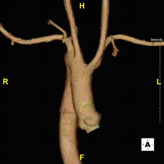 gore医疗怎么样「胸有乾坤」可调可控，从容不迫——GORE® TAG®可主动调控胸主动脉覆膜支架治疗右弓右降伴Kommerell憩室病例_https://www.jmylbn.com_新闻资讯_第6张