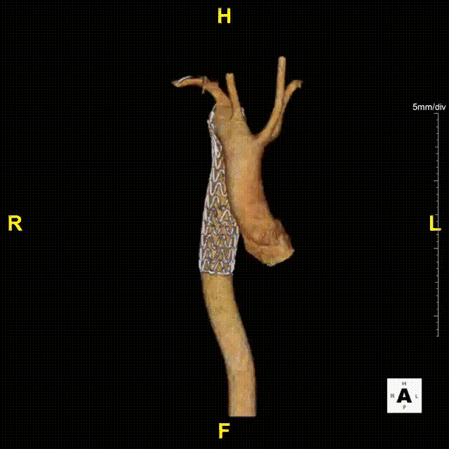gore医疗怎么样「胸有乾坤」可调可控，从容不迫——GORE® TAG®可主动调控胸主动脉覆膜支架治疗右弓右降伴Kommerell憩室病例_https://www.jmylbn.com_新闻资讯_第20张