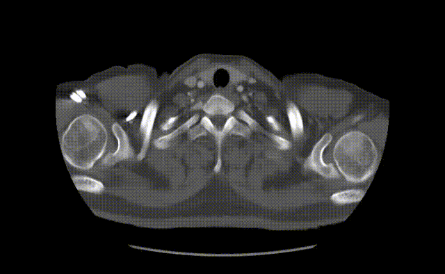 gore医疗怎么样「胸有乾坤」可调可控 分毫必争—GORE®TAG® 可主动调控胸主动脉覆膜支架治疗B型主动脉夹层伴升主动脉瘤病例报道_https://www.jmylbn.com_新闻资讯_第15张