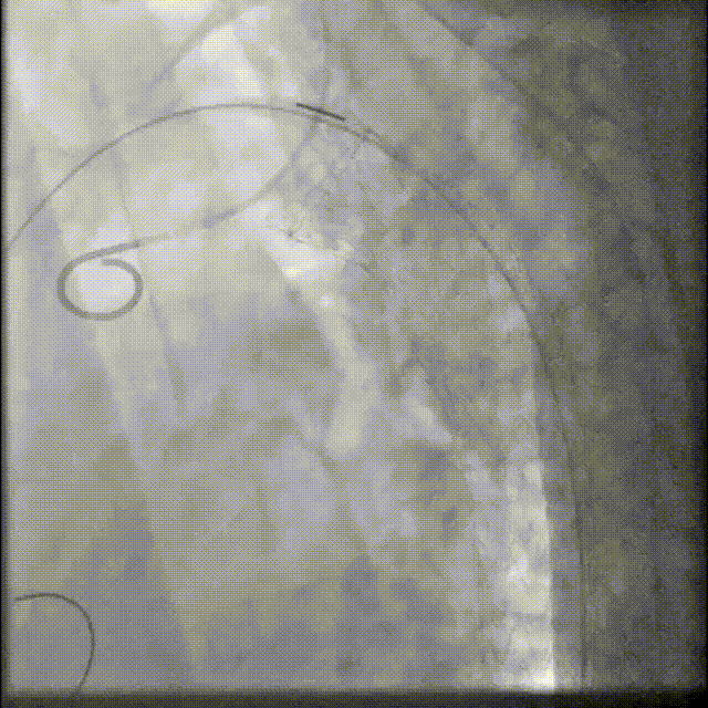 gore医疗怎么样「胸有乾坤」可调可控 分毫必争—GORE®TAG® 可主动调控胸主动脉覆膜支架治疗B型主动脉夹层伴升主动脉瘤病例报道_https://www.jmylbn.com_新闻资讯_第12张