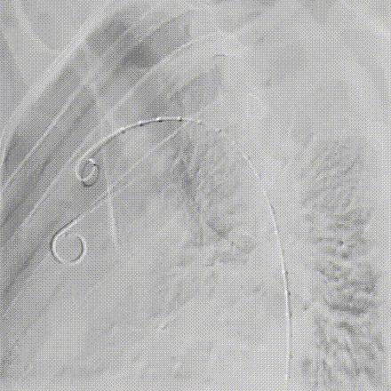 gore医疗怎么样「胸有乾坤」可调可控 分毫必争—GORE®TAG® 可主动调控胸主动脉覆膜支架治疗B型主动脉夹层伴升主动脉瘤病例报道_https://www.jmylbn.com_新闻资讯_第9张