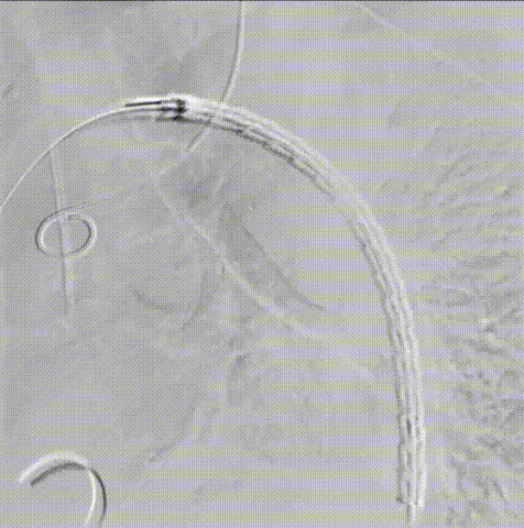 gore医疗怎么样「胸有乾坤」可调可控 分毫必争—GORE®TAG® 可主动调控胸主动脉覆膜支架治疗B型主动脉夹层伴升主动脉瘤病例报道_https://www.jmylbn.com_新闻资讯_第10张