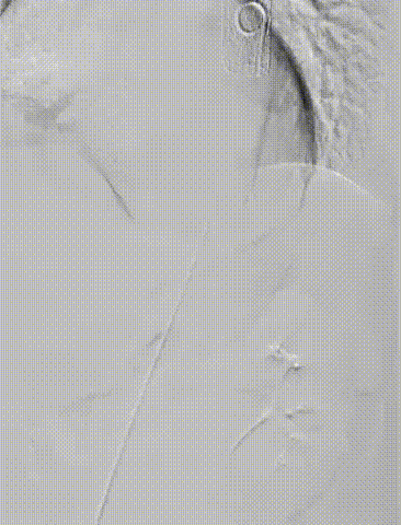 gore医疗怎么样「胸有乾坤」可调可控 分毫必争—GORE®TAG® 可主动调控胸主动脉覆膜支架治疗B型主动脉夹层伴升主动脉瘤病例报道_https://www.jmylbn.com_新闻资讯_第14张