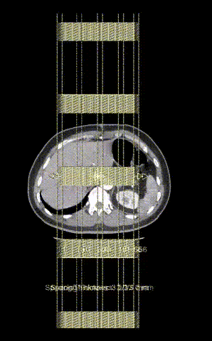 gore医疗怎么样「胸有乾坤」可调可控 分毫必争—GORE®TAG® 可主动调控胸主动脉覆膜支架治疗B型主动脉夹层伴升主动脉瘤病例报道_https://www.jmylbn.com_新闻资讯_第17张