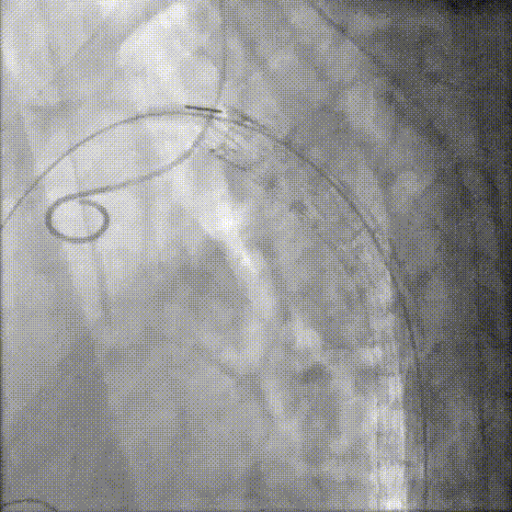 gore医疗怎么样「胸有乾坤」可调可控 分毫必争—GORE®TAG® 可主动调控胸主动脉覆膜支架治疗B型主动脉夹层伴升主动脉瘤病例报道_https://www.jmylbn.com_新闻资讯_第11张