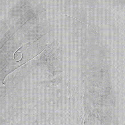 gore医疗怎么样「胸有乾坤」可调可控 分毫必争—GORE®TAG® 可主动调控胸主动脉覆膜支架治疗B型主动脉夹层伴升主动脉瘤病例报道_https://www.jmylbn.com_新闻资讯_第13张