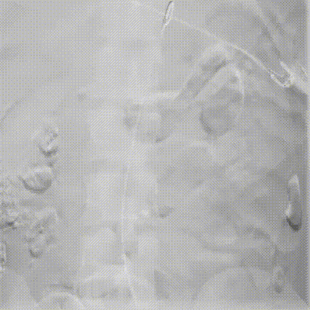 gore医疗怎么样「胸有乾坤」可调可控 分毫必争—GORE®TAG® 可主动调控胸主动脉覆膜支架治疗B型主动脉夹层伴升主动脉瘤病例报道_https://www.jmylbn.com_新闻资讯_第8张