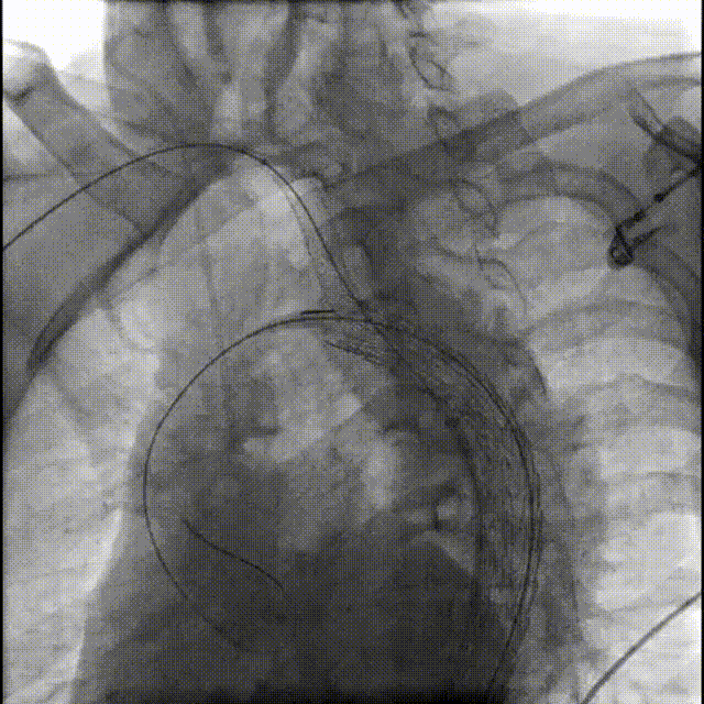 gore医疗怎么样「胸有乾坤」释半功倍 得心应手——GORE®TAG® 可主动调控胸主动脉覆膜支架治疗B型主动脉夹层病例分享 复旦大学附属中山医院_https://www.jmylbn.com_新闻资讯_第19张