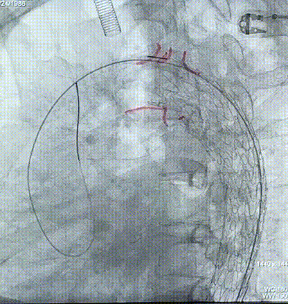 gore医疗怎么样「胸有乾坤」释半功倍 得心应手——GORE®TAG® 可主动调控胸主动脉覆膜支架治疗B型主动脉夹层病例分享 复旦大学附属中山医院_https://www.jmylbn.com_新闻资讯_第21张