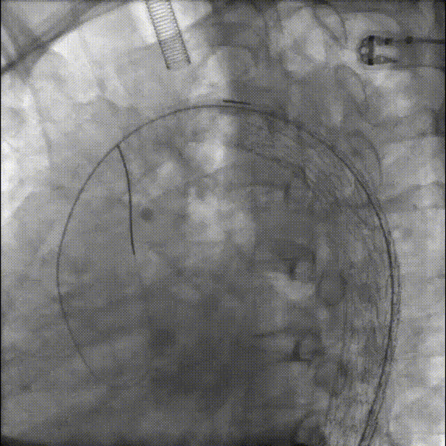 gore医疗怎么样「胸有乾坤」释半功倍 得心应手——GORE®TAG® 可主动调控胸主动脉覆膜支架治疗B型主动脉夹层病例分享 复旦大学附属中山医院_https://www.jmylbn.com_新闻资讯_第20张