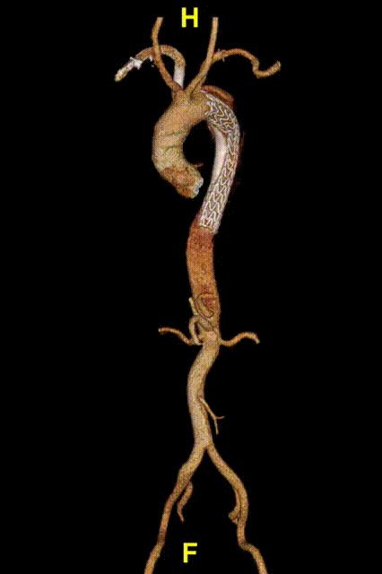 gore医疗怎么样「胸有乾坤」释半功倍 得心应手——GORE®TAG® 可主动调控胸主动脉覆膜支架治疗B型主动脉夹层病例分享 复旦大学附属中山医院_https://www.jmylbn.com_新闻资讯_第11张