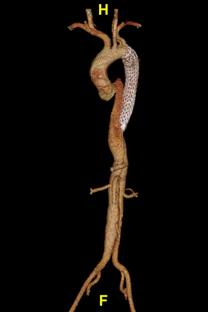 gore医疗怎么样「胸有乾坤」释半功倍 得心应手——GORE®TAG® 可主动调控胸主动脉覆膜支架治疗B型主动脉夹层病例分享 复旦大学附属中山医院_https://www.jmylbn.com_新闻资讯_第17张