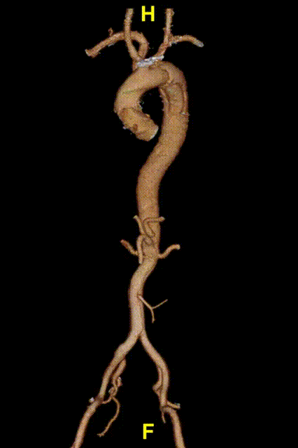 gore医疗怎么样「胸有乾坤」释半功倍 得心应手——GORE®TAG® 可主动调控胸主动脉覆膜支架治疗B型主动脉夹层病例分享 复旦大学附属中山医院_https://www.jmylbn.com_新闻资讯_第10张