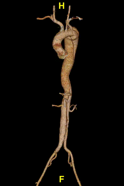 gore医疗怎么样「胸有乾坤」释半功倍 得心应手——GORE®TAG® 可主动调控胸主动脉覆膜支架治疗B型主动脉夹层病例分享 复旦大学附属中山医院_https://www.jmylbn.com_新闻资讯_第16张