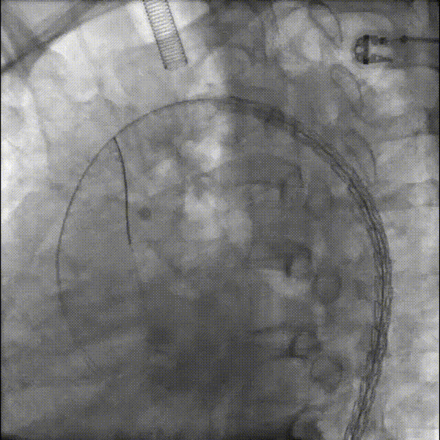 gore医疗怎么样「胸有乾坤」释半功倍 得心应手——GORE®TAG® 可主动调控胸主动脉覆膜支架治疗B型主动脉夹层病例分享 复旦大学附属中山医院_https://www.jmylbn.com_新闻资讯_第18张