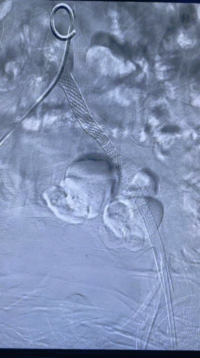 gore医疗怎么样【戈调·髂到好处】GORE VIABAHN VBX 球囊扩张血管内覆膜支架联合VIABAHN治疗长段髂动脉闭塞性病变的探索_https://www.jmylbn.com_新闻资讯_第14张