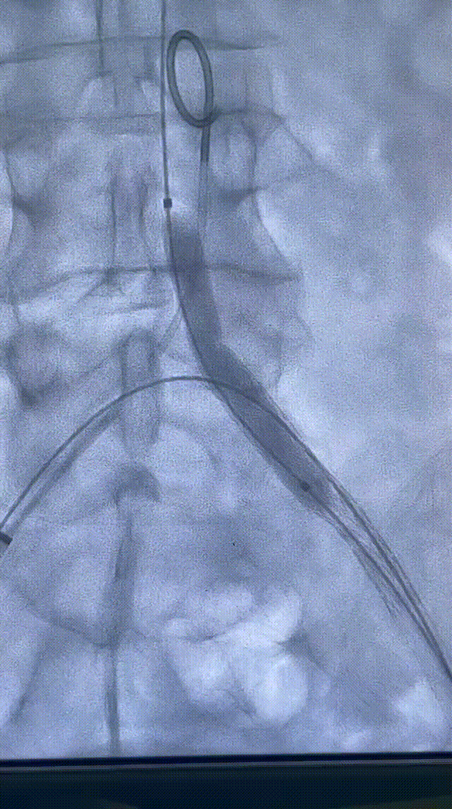 gore医疗怎么样【戈调·髂到好处】GORE VIABAHN VBX 球囊扩张血管内覆膜支架联合VIABAHN治疗长段髂动脉闭塞性病变的探索_https://www.jmylbn.com_新闻资讯_第12张