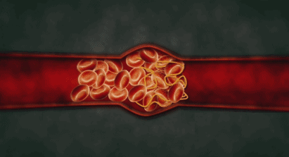 你轻视的慢性疲劳，其实是血管「微血栓」在作怪！