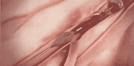 球囊怎么取出来血管里的斑块能取出来吗？心脏支架放进去，斑块去哪了？药物球囊和支架，哪个更好？_https://www.jmylbn.com_新闻资讯_第1张