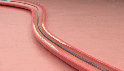 球囊怎么取出来血管里的斑块能取出来吗？心脏支架放进去，斑块去哪了？药物球囊和支架，哪个更好？_https://www.jmylbn.com_新闻资讯_第9张