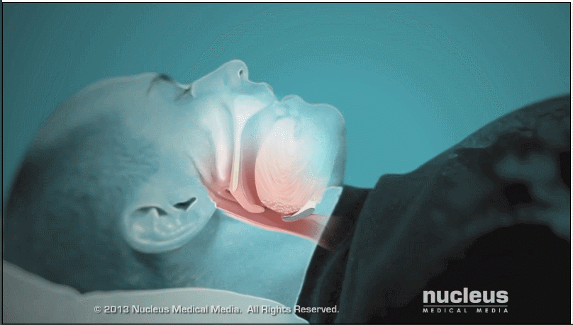 为什么叫双水平呼吸机关于双水平呼吸机的误解：双水平呼吸机效果好于单水平呼吸机_https://www.jmylbn.com_新闻资讯_第1张