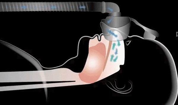 呼吸机呼吸压力怎么调家用无创呼吸机设置：IPAP压力如何调节？_https://www.jmylbn.com_新闻资讯_第1张