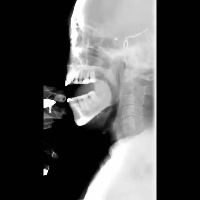 为什么要做吞咽仪器脑损伤后气管切开患者的吞咽功能康复（一）——评估篇_https://www.jmylbn.com_新闻资讯_第10张