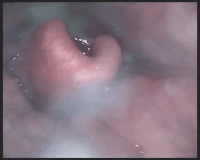 为什么要做吞咽仪器脑损伤后气管切开患者的吞咽功能康复（一）——评估篇_https://www.jmylbn.com_新闻资讯_第11张