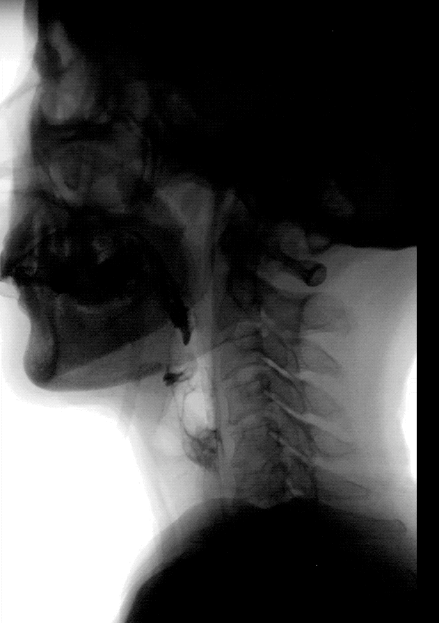 为什么要做吞咽仪器【阳光·科普】警惕老年人吃汤圆噎食！吞咽障碍早发现，教你初步自查→_https://www.jmylbn.com_新闻资讯_第9张
