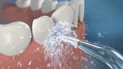 怎么选洁牙器械同样是洗牙，价格差距怎么这么大？_https://www.jmylbn.com_新闻资讯_第9张