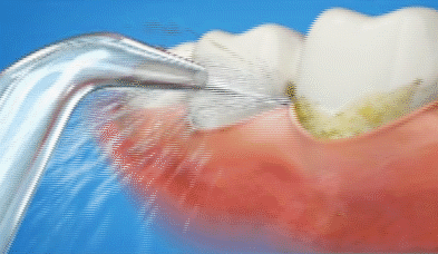 怎么选洁牙器械同样是洗牙，价格差距怎么这么大？_https://www.jmylbn.com_新闻资讯_第5张